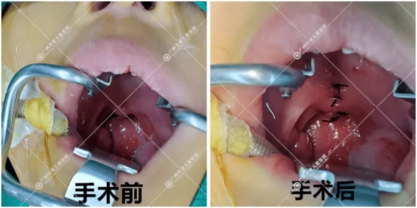 窪裂脣排修复手术顺利完成术后恢复良好现已出院