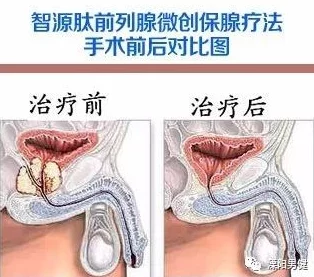 前列腺电击调教bdsm最新研究显示前列腺刺激可增强性快感并改善性健康