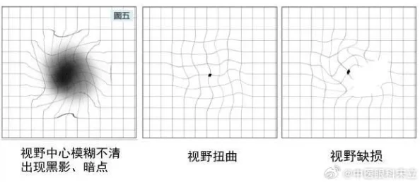 神级透视副作用严重慎用或致视力永久性损伤